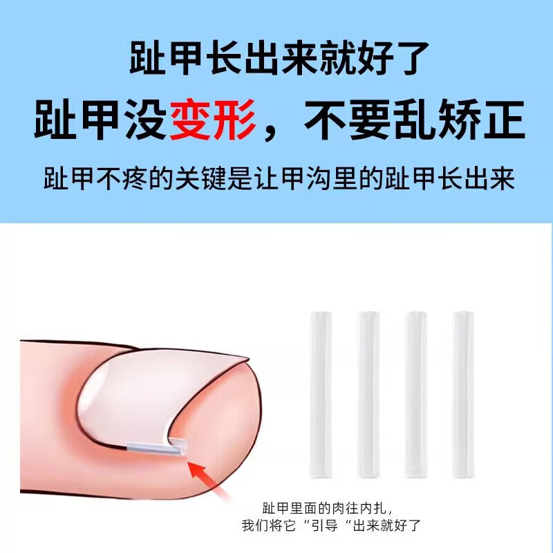 Jebis paronychia correction toenail correction corrector isolation filling pad toenail long in the flesh trimming artifact