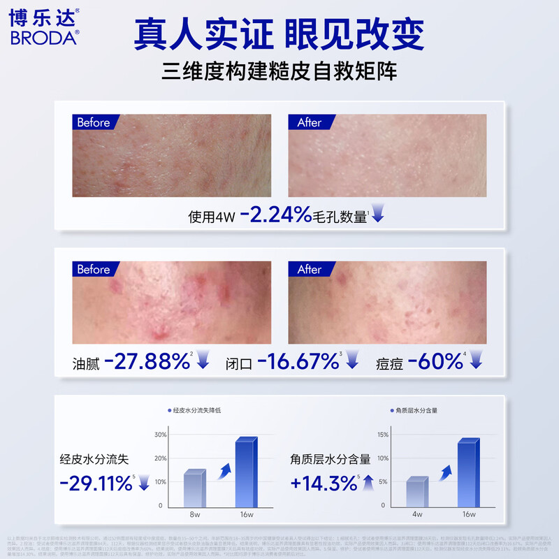 Boleda salicylic acid removes acne, removes blackheads, removes closed acne, nourishes and repairs, non-fruit acid oil control mask 35g