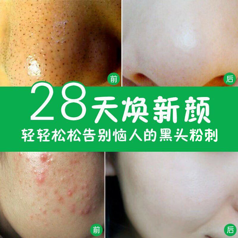 Baozilai Peel-off Blackhead Mask Set Cleans Blackheads Nose Export Bamboo Charcoal Mud Mask Men and Women Apply Mask