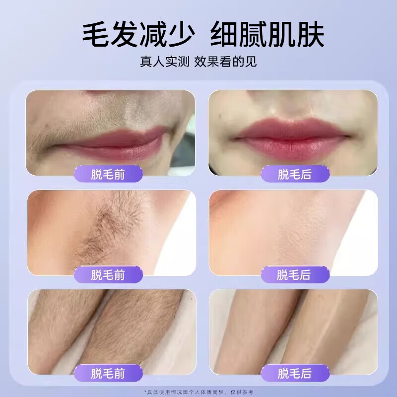 CKULH World Champion Recommends German Hair Removal Device Freezing Point Home Laser Full Body Hair Removal Does Not Hurt the Skin Sapphire Hair Removal Device Private Part Shaving Legs Armpit Lip Hair Painless Ice Brilliant Purple Freezing Point Pro - Powerful Hair Removal + Freezing Point Painless High-end Flagship Freezing Point Painless Hair Removal丨5 Modes