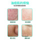 Wing Yan Azelaic Acid 15% Gel Salicylic Acid Pore Refinement Cream Ointment Acne Clearing Gel Blackhead Cream 30g 1 set