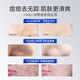 SUMDOY Japan imported mite removal and acne removal amino acid facial cleanser to control oil removal of blackheads and pores, men and women's facial cleanser [Double repair] acne removal cream + facial cleanser