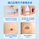 
Nurse classmate stoma leakage protection ring 12035 same plastic patch ring chassis leakage protection seal elastic glue stoma care products [10 pieces/box] 4mm stoma leakage protection ring