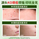 Hikari Island's acne patch anti-inflammatory and pus-absorbing medical acne mark repair thin invisible artificial skin 108 patches