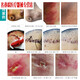 
9930 Medical Wound Disinfection Sterilizer Burn Scald Trauma Surgery Household Non-alcohol Disinfection Anti-Infection Spray New Model