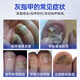 Shibuoka Pharmaceutical Japan's special onychomycosis, severe onychomycosis, yellowing fungal infection, effective non-medicinal removal of onychomycosis*3 boxes