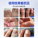 Shibuoka Pharmaceutical Japan's special onychomycosis, severe onychomycosis, yellowing fungal infection, effective non-medicinal removal of onychomycosis*3 boxes