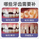 Dental filling artifact, self-filling material, medical 3m American technical resin temporary cavity denture adhesive, buy 2, get 1 free, hot sale, can fill about 12 teeth
