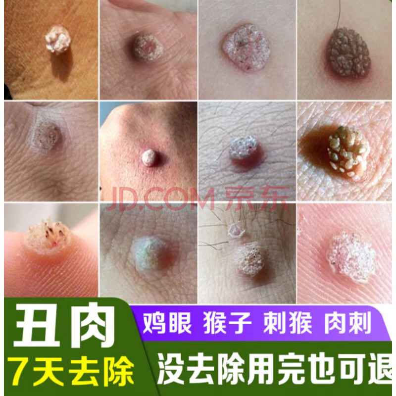 鸡乌眼膏贴去猴子肉粒疙瘩手上长刺猴去除瘊子脚底鱼鳞痣去疣灵 黑瓶