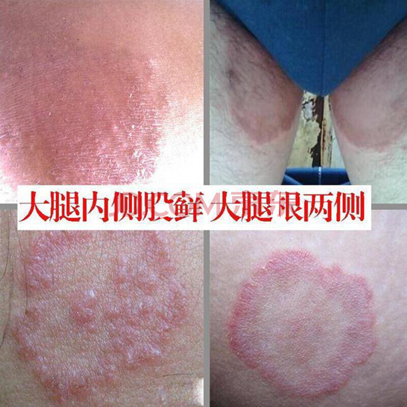 睿医堂本舒宁官网 软膏止痒成人顽固皮肤止痒阴囊肛周湿痒朴宗岳童秋