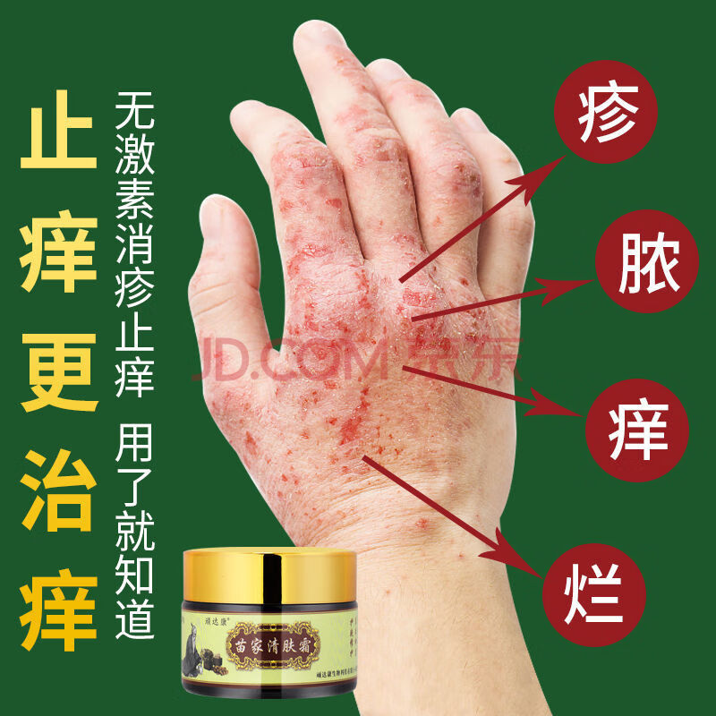 皮肤瘙痒止痒膏汗i疱i疹湿疹去湿根成人手脚水泡刺痒拔i毒断痒止痒王