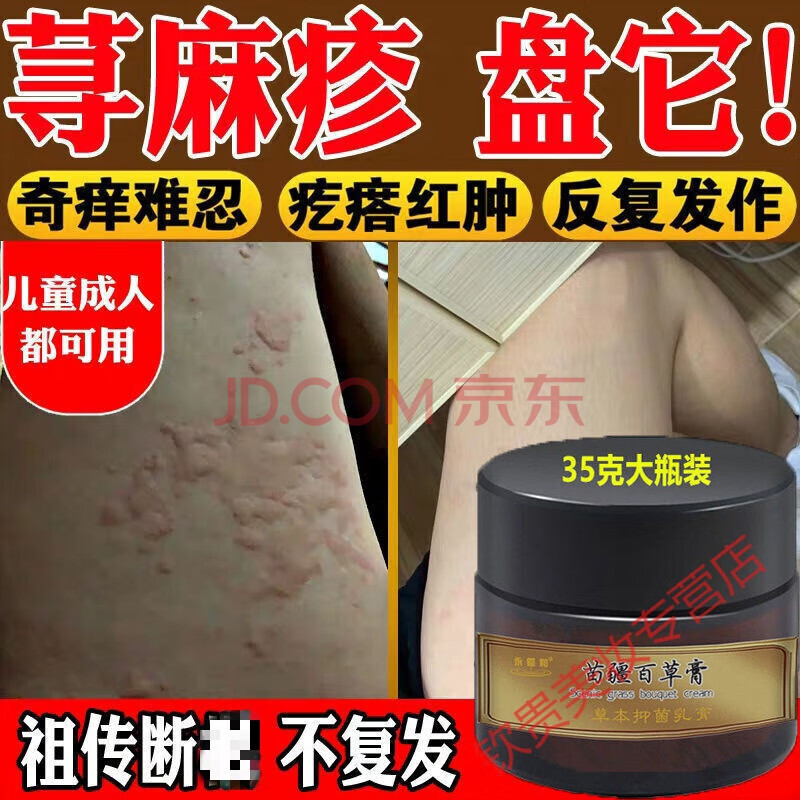 人工荨麻疹能用身体乳吗(荨麻疹皮肤干燥可以用身体乳吗) 人工荨麻疹能用身体乳吗(荨麻疹皮肤干燥可以用身体乳吗)