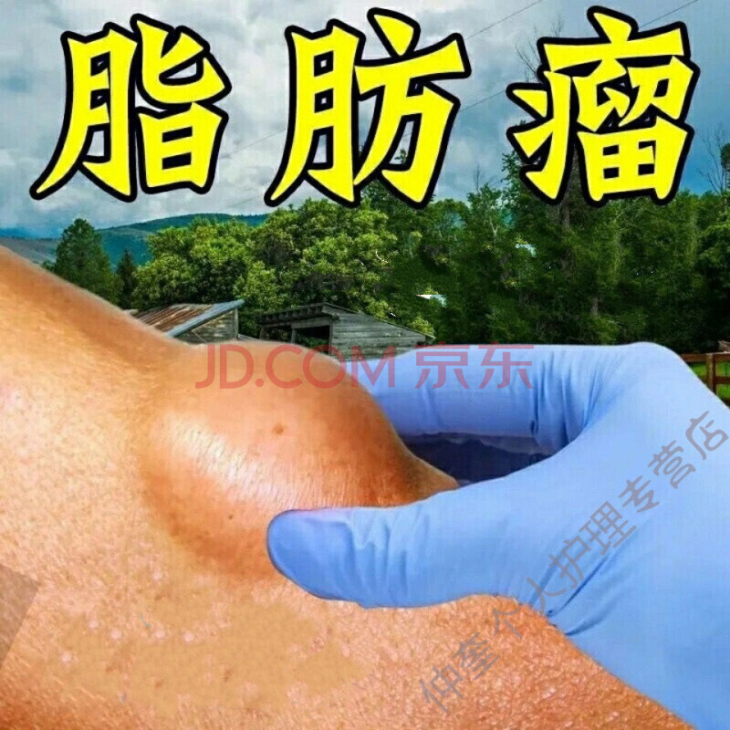 【脂肪瘤99%痊愈】专消36种皮下多发性脂肪瘤硬块肿块局部包块去粉瘤