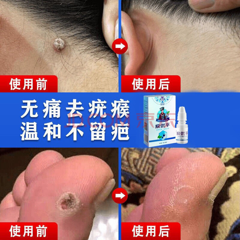 疣立净去猴子肉粒鸡眼去刺猴丝状i疣膏脖子颈部疣瘊灵去除皮赘疣必清