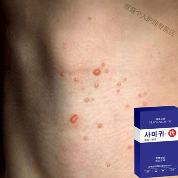 去除脖子小肉粒小猴子颈部赘皮扁平尤丝l状疣腋下疣专用液一盒装