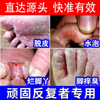 施恩德脚气止痒治脚痒水泡脱皮去脚趾缝烂痒糜烂根干裂jm 1盒足舒 1盒足邦 图片价格品牌报价 京东 施恩德脚气止痒治脚痒水泡脱皮去脚趾缝烂痒糜烂根干裂jm 1盒足舒 1盒足邦 图片价格品牌报价 京东