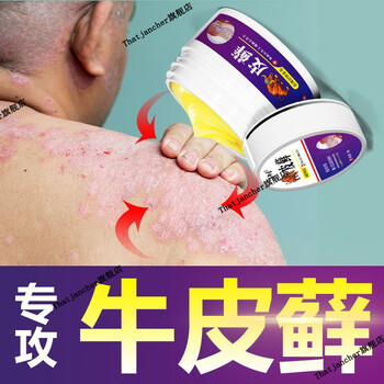 日本研发牛l皮l廯银l屑专用顽固性手足头皮l藓体股l藓皮l炎湿l疹止痒