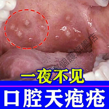 口腔天疱疮一晚冶好口腔粘膜糜烂上颚疼水泡化脓口i臭杀l菌喷剂买3送