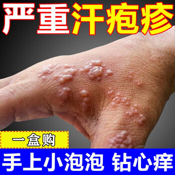 汗疱疹药膏手上小水泡皮肤用药福元阿昔洛韦乳膏单纯疱疹带状疱疹感染