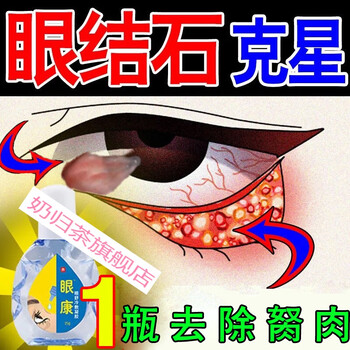 眼结石老花眼滴研眼液去除ll眼睛胬肉迎风流泪红血丝修复眼约液抗皮疲