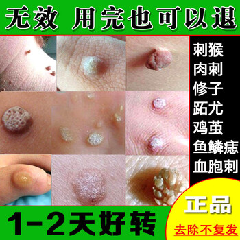 【京健康】猴去除鱼鳞痣手足部肉刺膏点治候药瘊子神跖尤血胞刺灵