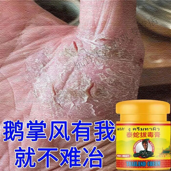 泰蛇膏手1癣膏手足1癣真菌感染水泡手痒脱皮干裂皮1焱湿1疹鹅掌风膏一