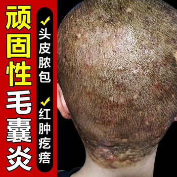 诗莱格毛囊炎洗发水 去屑止痒去头皮螨虫洗发水男女控油洗发露 一瓶装