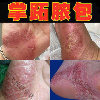 脚气药粉_去脚气的药粉_治脚气最有效的药粉