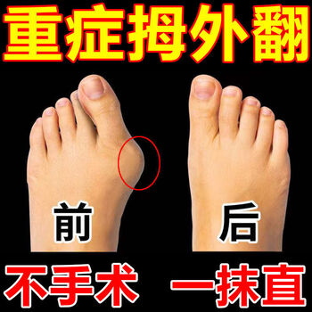 拇外翻贴【彻底】拇指外翻器大脚骨变形脚趾重叠前掌鞋垫 灭大脚骨