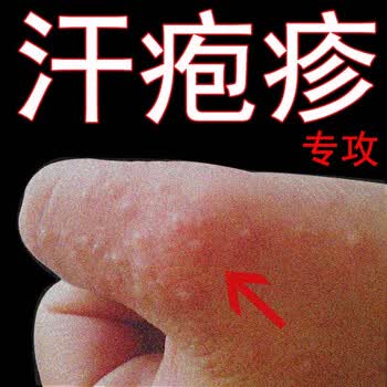 尼坤软膏仁瑞堂尼坤软膏 手起水泡止痒草本乳膏手痒脱皮抑1菌汗泡膏