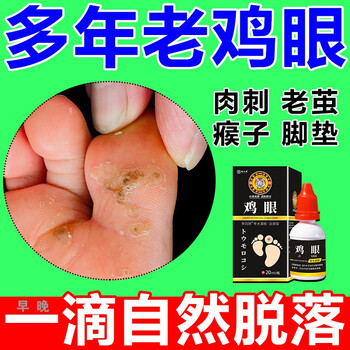 械の源【当天鸡眼掉】去鸡眼药水抑菌液去脚部手部鸡眼肉刺肉粒疙瘩