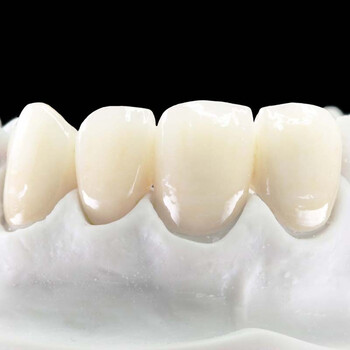 Dr Wells 承新牙醫診所 台北牙醫植牙矯正微笑設計美白 讓全鋯假牙擺脫進食貼片剝落的窘境