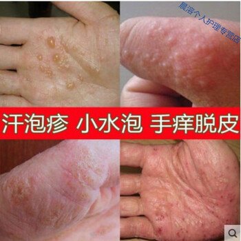 治汗l疱l疹鹅掌风手足l廯季节性手痒脱皮真菌感染手上起小水泡止l痒膏