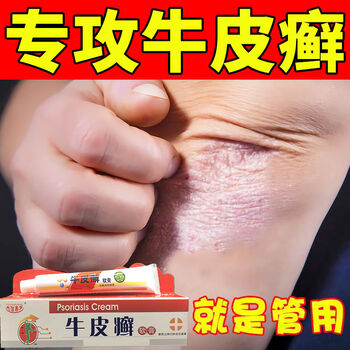 牛皮1癣专用乳膏顽固性神经性皮1焱手足1癣银1屑病皮肤瘙痒止痒老偏方