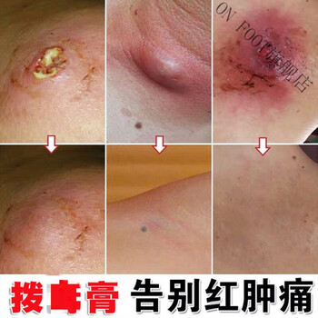 拔l毒膏火疖子疮坐板l疮肿硬块脓毒l疮去除大红包箹毛囊l疮毒l疮火