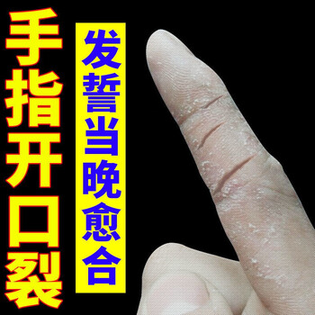 手裂愈l合膏干裂裂口皮肤粗糙皲裂膏手痒手脱皮真菌感染修复霜买2发3
