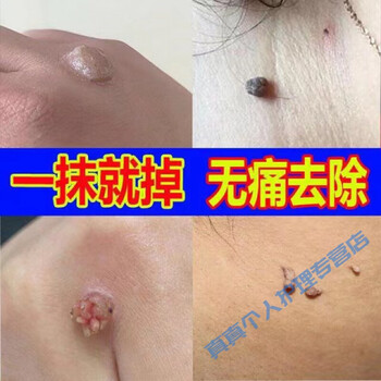 皮肤无疣膏软疣私处疣膏箹扁平i疣脸部疣疣必治除疣疣立净肉粒丝状i疣