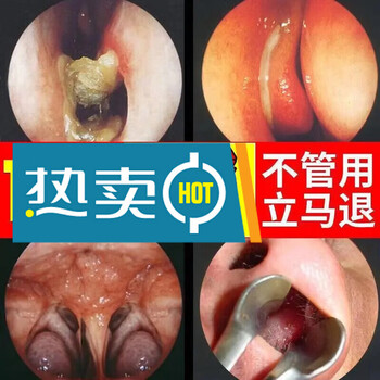 鹅不食草鼻炎膏过敏性鼻炎神器鼻窦炎鼻塞通鼻鼻甲肥大周期装买二发三