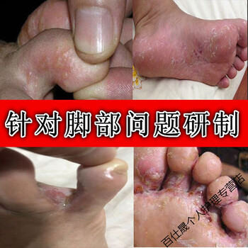 喷剂脚痒水泡脱皮脚趾缝糜烂臭汗烂i脚丫开裂脚喷剂脚痒水泡脱皮脚趾