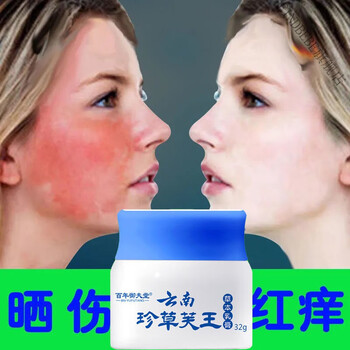 【紫外线过敏】日光性皮l炎皮肤晒伤过敏红l肿瘙痒脱皮抑l菌止l痒膏