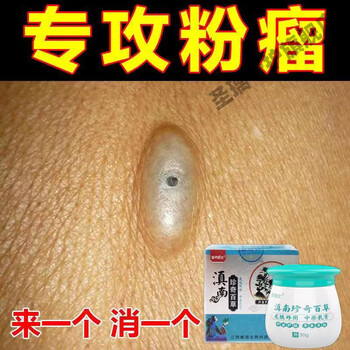 粉瘤膏皮脂腺囊肿专用疏通皮脂腺堵塞皮下脓包肿块多年粉瘤特孝膏买二