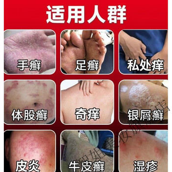 夫洁美宝湿l毒清软膏湿毒清中草软膏止痒膏牛l皮l癣膏湿l疹膏皮l炎