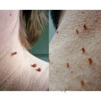 去疣灵肉粒丝状疣去除颈部扁平疣面部去疣灵专用脖子上的小肉粒疙瘩