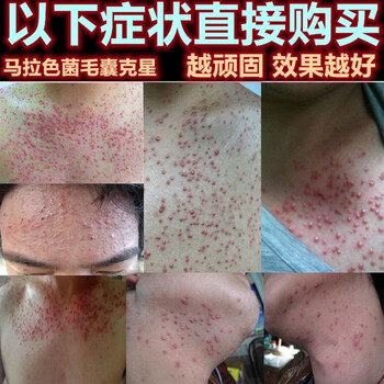 毛囊炎马拉色菌箹头皮后脑勺背部腋下胸口四肢去除皮囊l炎祛痘痘皮肤