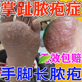掌趾脓疱症剥脱性窝状角质松解症手脚蜕皮干裂瘙痒脚皮症外用喷剂