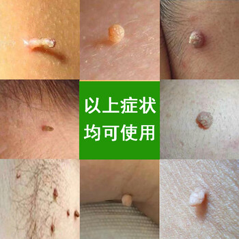 去除神i器去猴子肉粒疙瘩脖子上长刺猴凸痣点猴子箹