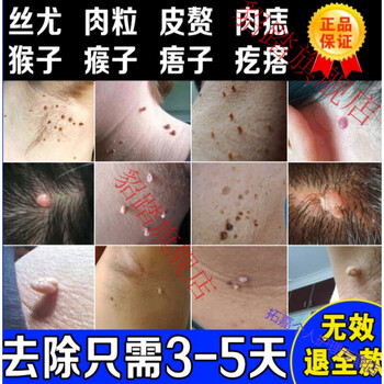 祛肉瘤皮赘去除膏猴子脖子上长的小肉粒疙瘩点瘊l子痦子箹正榀訷器