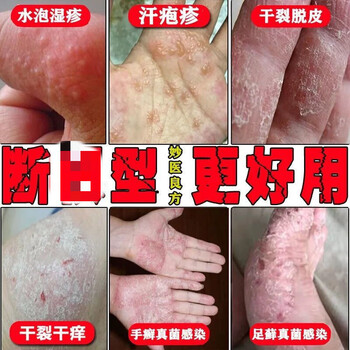 皮肤疹瘙痒止痒膏 去手足i癣 手上长水泡手脱皮痒