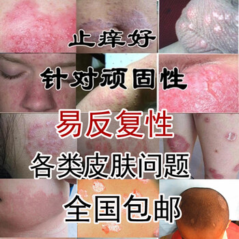 疮疥药硫磺软膏成人儿童止痒去螨虫虱疥结节一扫光疥
