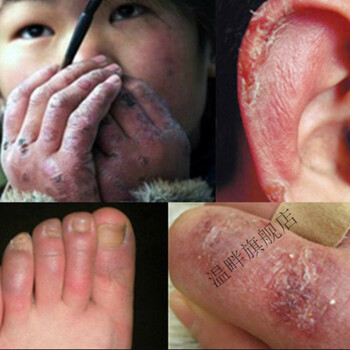 冰王金鳄油冻l疮膏冻伤膏手脚耳朵脸红冻伤冻裂防裂消l肿止痒护手霜